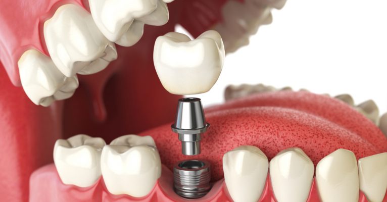 dental implants