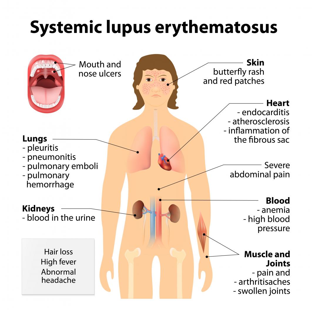 lupus-symptoms