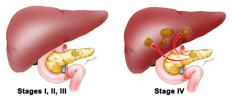 pancreas-stage